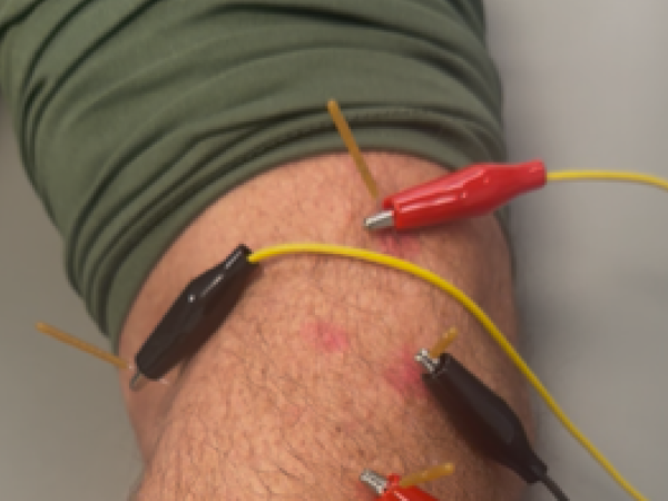 needling