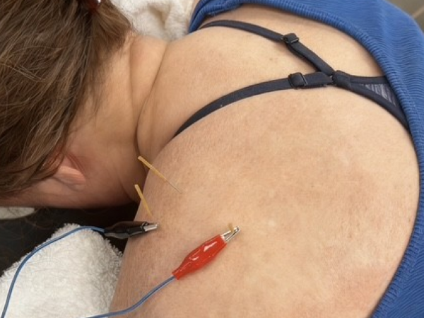 needling therapy image